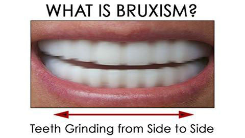 What is Bruxism?